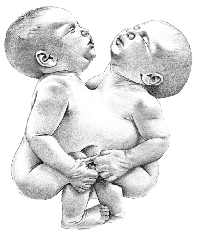 conjoined-twins